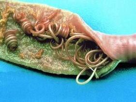 Gizakiaren gorputzean parasitoen arrazoiak