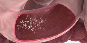 Parasitoak kentzeko hirukoitzak erabiltzea
